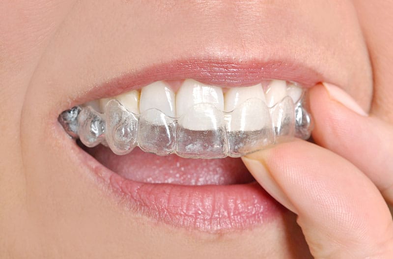 Invisalign La Jolla