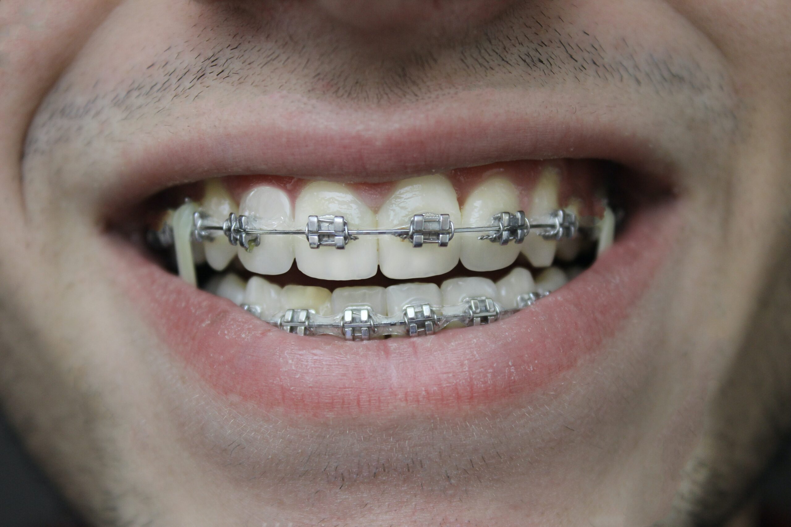 Clear Braces vs Metal Braces